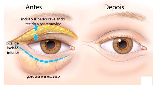 cirurgia de blefaroplastia